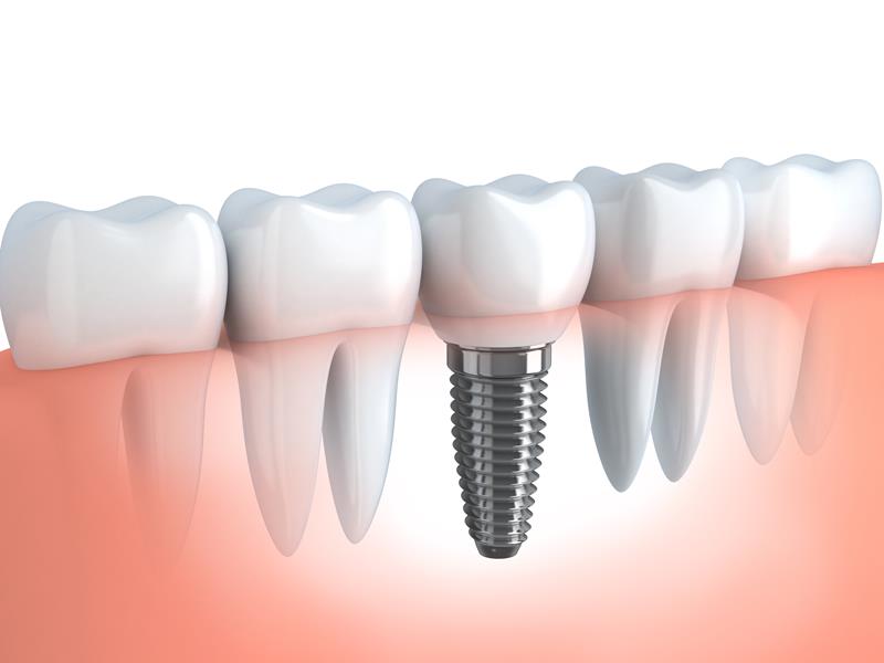Dental Implants  Street Cooper City, FL 