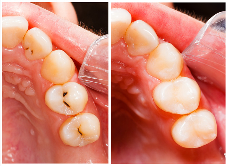 Fillings Street Cooper City, FL