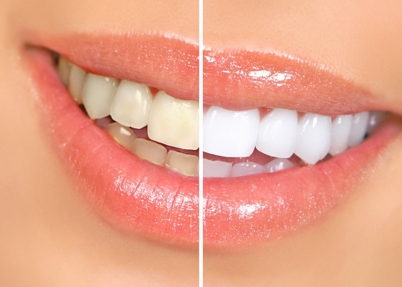 Teeth Whitening Street Cooper City, FL